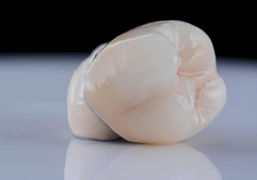 Glass ceramic dental veneers and porcelain crowns displayed for smile design treatment, including laminate veneers and porcelain bridges.