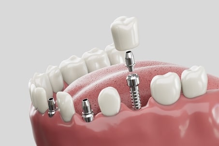 Side view 3D illustration of dental implant procedure for tooth replacement